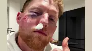 Ben Stokes Undergoes Surgery After Cricket Ball Injury, Vows to Always Wear Helmet