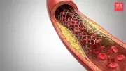 Laser Angioplasty: Debunking Myths and Understanding Its Real Medical Role