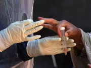 Maharashtra's Sickle Cell Campaign Identifies 9,700 New Cases, 82,000 Carriers