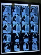 Rare Lung Tumor Overcome: Nadiad Girl's Journey to Health After Aggressive Cancer Battle