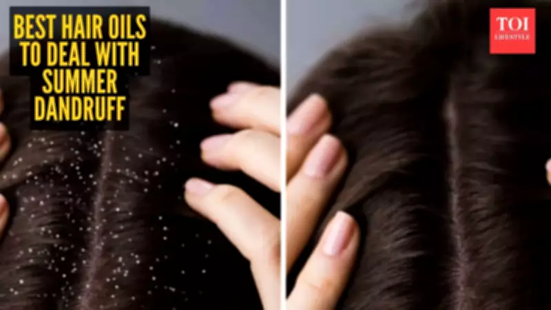 5 Best Hair Oils to Combat Summer Dandruff Naturally