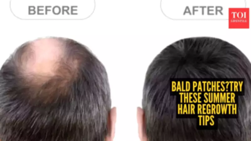 5 Easy Summer Hair Regrowth Tips for Bald Patches: Beat Heat & Stress