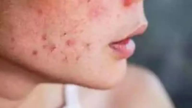 Acne Scars Run Deeper Than Thought, New Delhi Study Reveals Treatment Challenges
