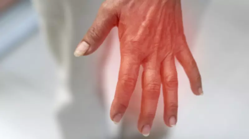 Bengaluru Doctors Report Post-Pandemic Surge in Guillain-Barré Syndrome Cases