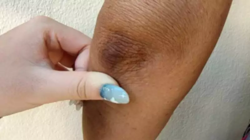 Beyond the Neck: The Hidden Signs of Acanthosis Nigricans You Might Miss