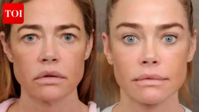 Denise Richards' Facelift Journey Goes Viral: Before & After Photos Revealed