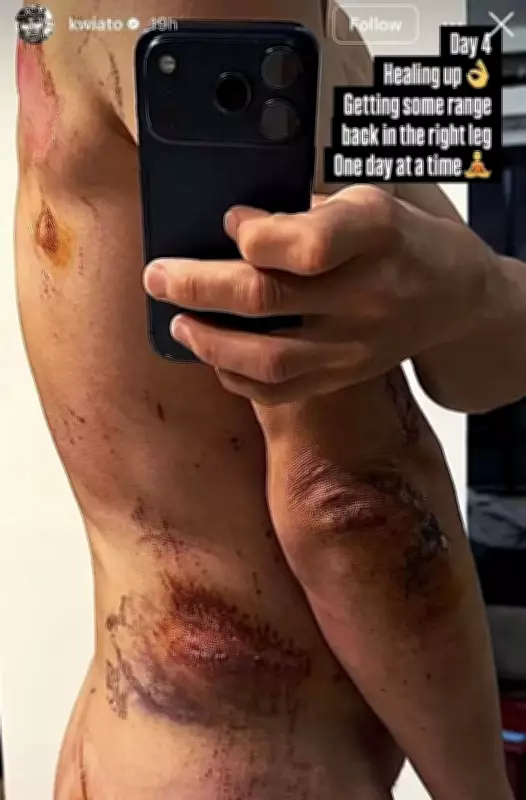 Michal Kwiatkowski Reveals Brutal Injuries After Milan-San Remo Crash