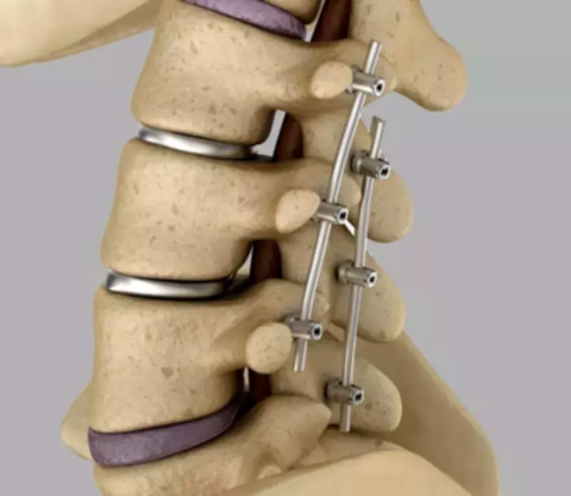 Middle East Conflict Disrupts Titanium Implant Supply, Threatens Patient Care in India