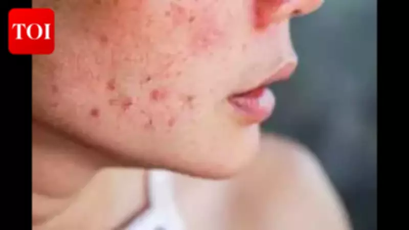 New Delhi Study Reveals Why Acne Scars Persist: Depth Mismatch with Treatments
