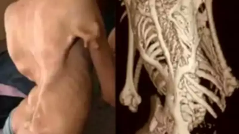 Rare 'Stone Man Syndrome' Case Confirmed in Rajasthan for First Time