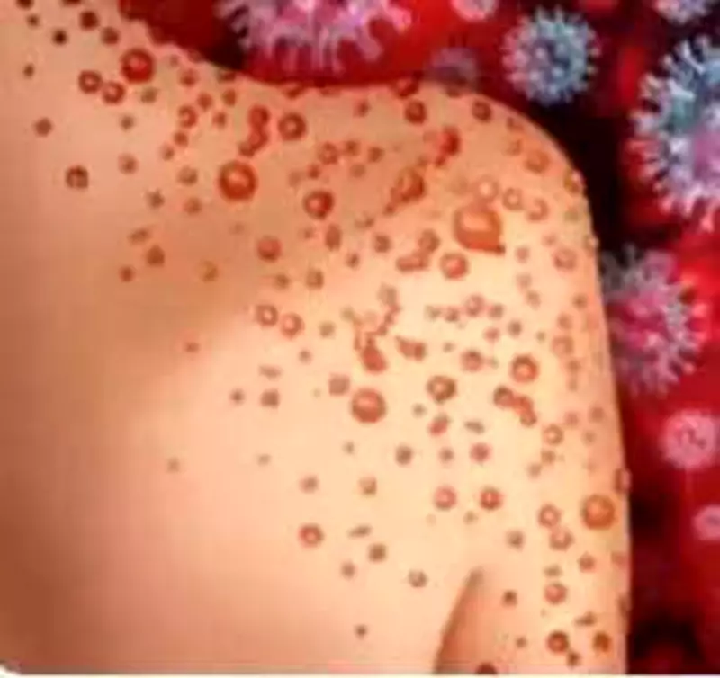 Tamil Nadu Reports Over 800 Chickenpox Cases; Health Department Intensifies Surveillance