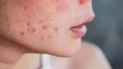 Acne Scars Run Deeper Than Thought, New Delhi Study Reveals Treatment Challenges