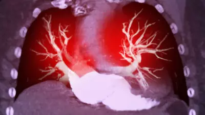 AHA/ACC Release First-Ever Guideline for Acute Pulmonary Embolism Treatment