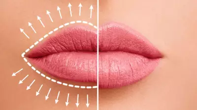 Natural Look Lip Fillers Trend Explained by Beauty Experts