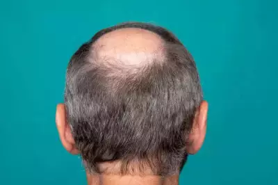 New Study Reveals Gut Health Crisis Is Driving Hair Loss in Indian Men