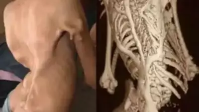 Rare 'Stone Man Syndrome' Case Confirmed in Rajasthan for First Time