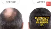 5 Easy Summer Hair Regrowth Tips for Bald Patches: Beat Heat & Stress