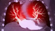 AHA/ACC Release First-Ever Guideline for Acute Pulmonary Embolism Treatment