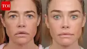Denise Richards' Facelift Journey Goes Viral: Before & After Photos Revealed