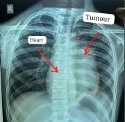 Raipur Hospital Claims World First: 11-Year-Old Boy Survives Rare Thymic Cancer Surgery