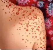 Tamil Nadu Reports Over 800 Chickenpox Cases; Health Department Intensifies Surveillance