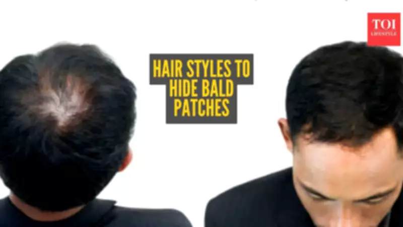 Alopecia Areata: 5 Smart Hairstyles to Naturally Conceal Bald Patches