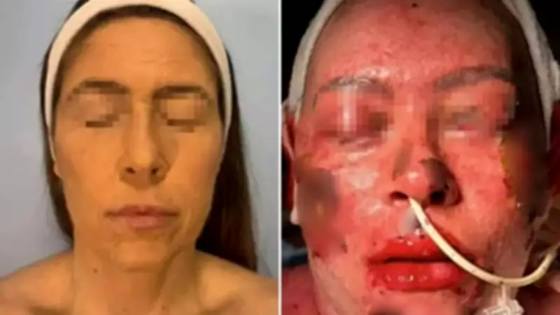 Brazilian Woman Loses 55% of Skin After Taking Common Antidepressant