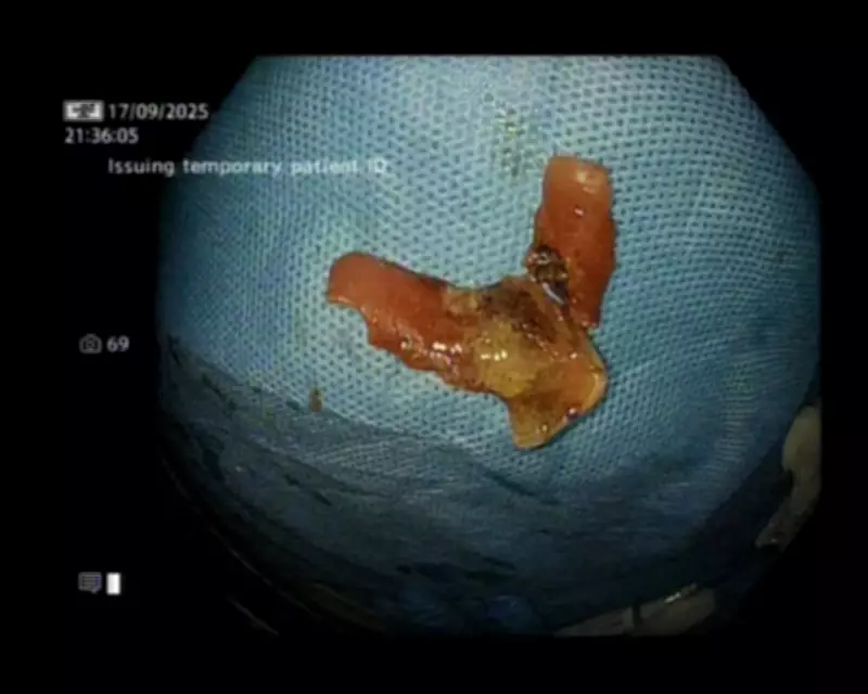 Denture Lodged in Food Pipe Removed with Laser Endoscopy in Delhi Hospital