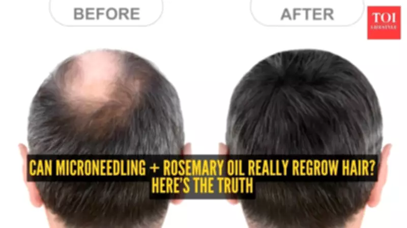 Microneedling and Rosemary Oil for Hair Loss: Science and Routine