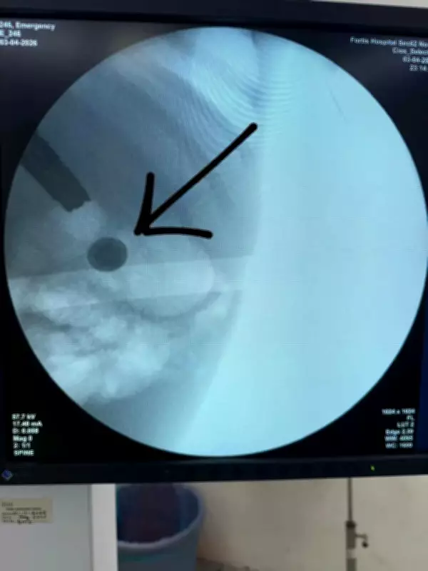 Noida Doctors Save Toddler After She Swallows Lithium Button Battery from Toy