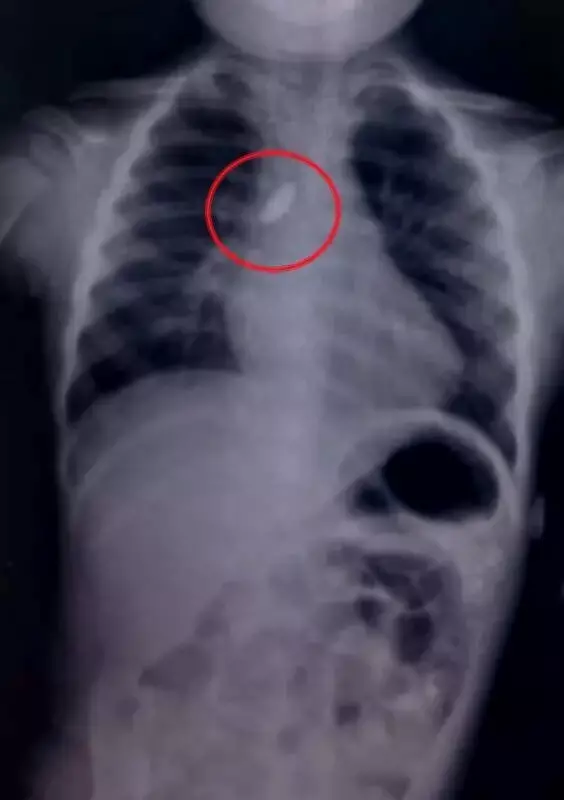 Pune Doctors Save Toddler by Removing Stone from Airway in Emergency Surgery