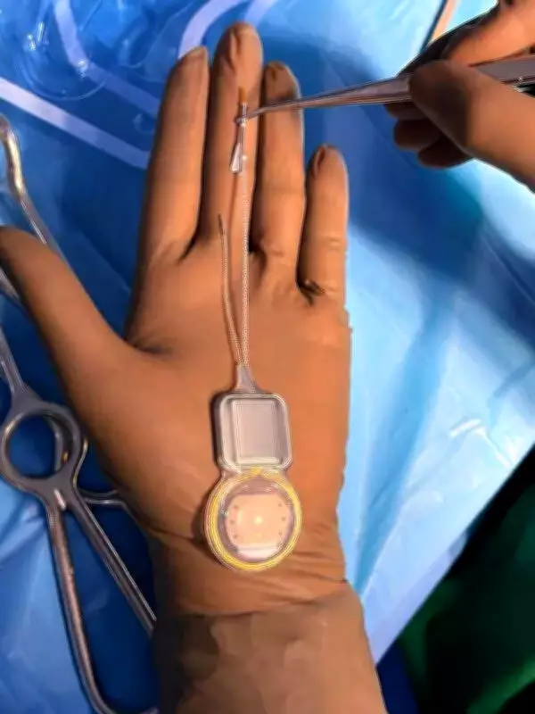 Pune Girl Hears for First Time with Future-Ready Smart Cochlear Implant