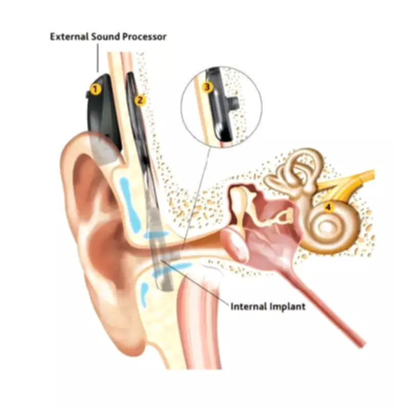 Pune Man Overcomes Deafness and Depression with Advanced Cochlear Implant