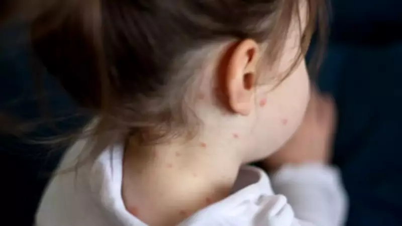 Suspected Measles Outbreak in Palamu Villages: Health Officials on Alert