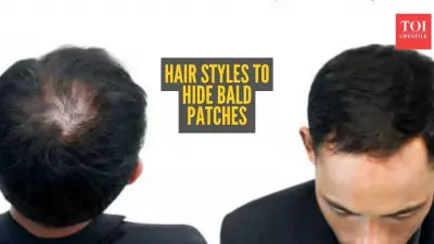 Alopecia Areata: 5 Smart Hairstyles to Naturally Conceal Bald Patches