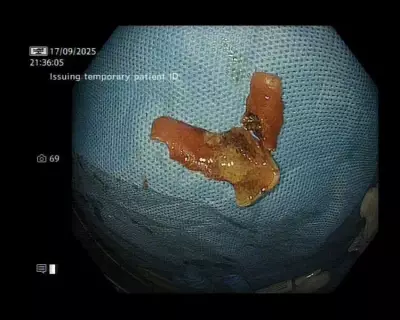 Denture Lodged in Food Pipe Removed with Laser Endoscopy in Delhi Hospital