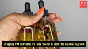 Alopecia Areata Remedies: Top Hair Oil Blends for Fast Growth in Bald Patches