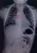 Pune Doctors Save Toddler by Removing Stone from Airway in Emergency Surgery