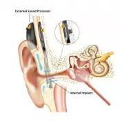 Pune Man Overcomes Deafness and Depression with Advanced Cochlear Implant