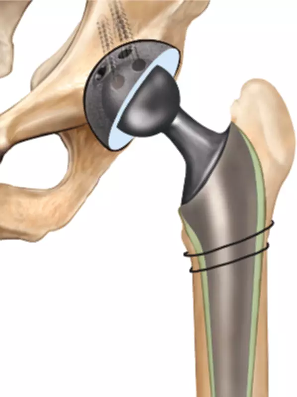 91-Year-Old Mumbai Man Undergoes Hip Replacement to Avoid Bed Rest