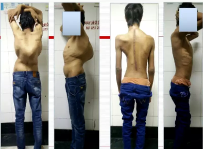 AIIMS Pioneers Safer, More Reliable Spine Surgery Technique for Patients
