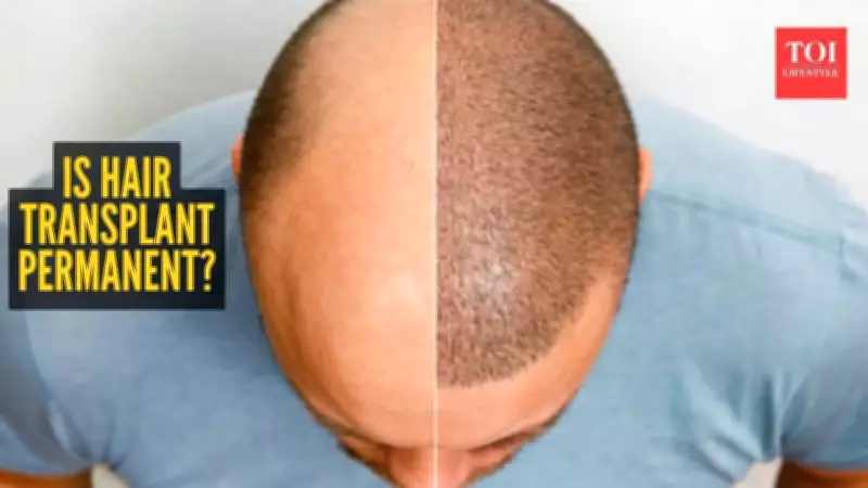 Hair Transplant Permanence: 500-Case Study Reveals Long-Term Results