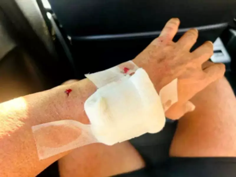 Marathon Runner Injured in Stray Dog Attack During Training