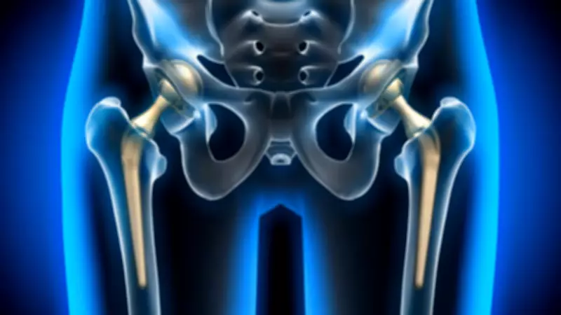 Minimally Invasive Hip Replacement Restores Mobility in Hours for Ankylosing Spondylitis Patient