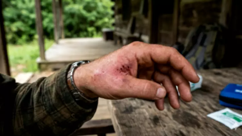 Snake Bite Myths: Why Sucking Venom Is Dangerous and Ineffective