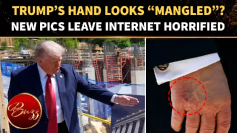 Trump’s Bruised Hand Photos Spark Health Rumors Ahead of Medical Exam