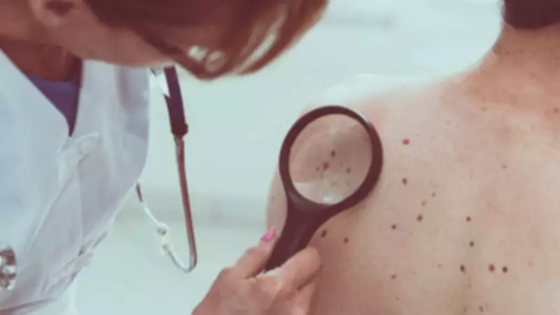UK Melanoma Cases Hit Record High, Projected to Rise 26% by 2040