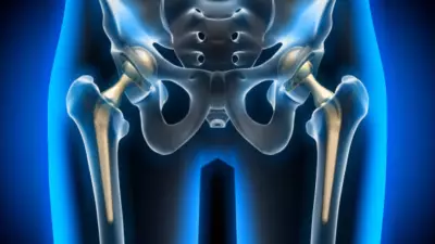 Minimally Invasive Hip Replacement Restores Mobility in Hours for Ankylosing Spondylitis Patient