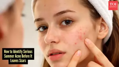 Summer Acne Stages: When to Visit a Dermatologist for Breakouts
