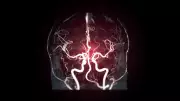 Cerebral Angiography: Vital Test for Brain Vascular Health